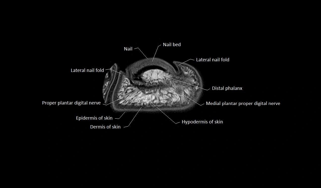 Great toe (hallux) axial microanatomy 3T MRI image 7.webp